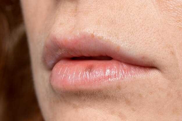 Что такое герпес на губах?